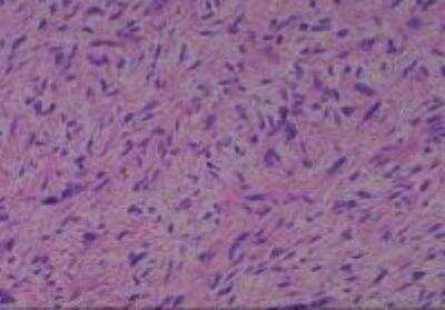 Hematoxylin & Eosin Stain: Human Lipomatous Tissue MicroArray (Tumor) [NBP2-30241] -  26. Soft Tissue, retroperitoneal liposarcoma