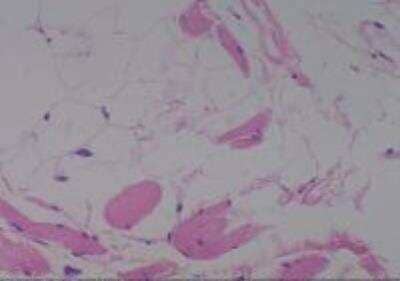 Hematoxylin & Eosin Stain: Human Lipomatous Tissue MicroArray (Tumor) [NBP2-30241] - 32. Soft Tissue, thigh liposarcoma, Well differentiated