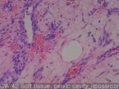 Hematoxylin & Eosin Stain: Human Lipomatous Tissue MicroArray (Tumor) [NBP2-30241] -  42. Soft tissue, pelvic cavity liposarcoma