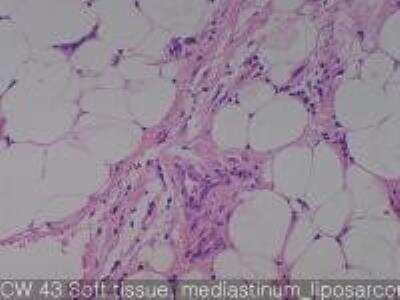 Hematoxylin & Eosin Stain: Human Lipomatous Tissue MicroArray (Tumor) [NBP2-30241] - 43.  Soft tissue mediastinum liposarcoma