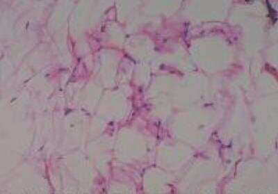 Hematoxylin & Eosin Stain: Human Lipomatous Tissue MicroArray (Tumor) [NBP2-30241] - 44. Soft tissue, thigh mediastinum liposarcoma