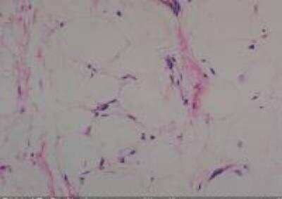 Hematoxylin & Eosin Stain: Human Lipomatous Tissue MicroArray (Tumor) [NBP2-30241] -  45. Soft tissue, afilla liposarcoma, Well differentiated