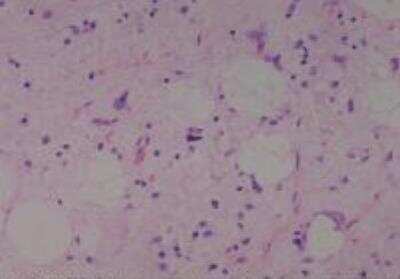 Hematoxylin & Eosin Stain: Human Lipomatous Tissue MicroArray (Tumor) [NBP2-30241] -  59. Soft tissue, abdominal cavity, Liposarcoma