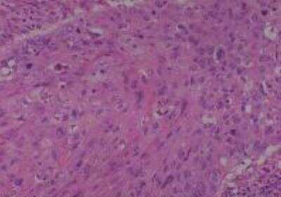 Hematoxylin & Eosin Stain: Human Lung Tissue MicroArray (Cancer metastasis) [NBP2-30222] -  01. Lung Squamous cell carcinoma