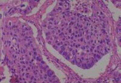 Hematoxylin & Eosin Stain: Human Lung Tissue MicroArray (Cancer metastasis) [NBP2-30222] -  02. Lung squamous cell carcinoma
