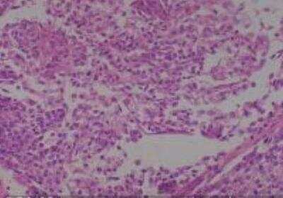 Hematoxylin & Eosin Stain: Human Lung Tissue MicroArray (Cancer metastasis) [NBP2-30222] - 03. Lung, squamous cell carcinoma