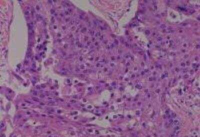 Hematoxylin & Eosin Stain: Human Lung Tissue MicroArray (Cancer metastasis) [NBP2-30222] - 04. Lung squamous cell carcinoma