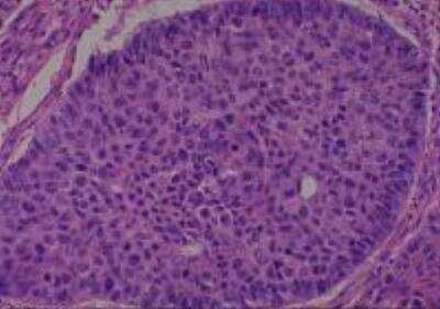 Hematoxylin & Eosin Stain: Human Lung Tissue MicroArray (Cancer metastasis) [NBP2-30222] -  05. Lung squamous cell carcinoma