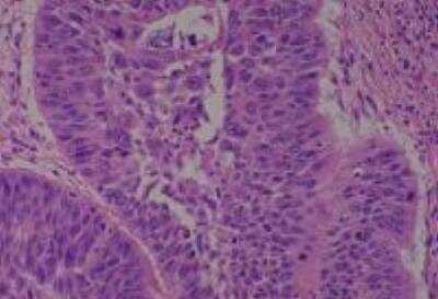 Hematoxylin & Eosin Stain: Human Lung Tissue MicroArray (Cancer metastasis) [NBP2-30222] -  06. Lung, squamous cell carcinoma