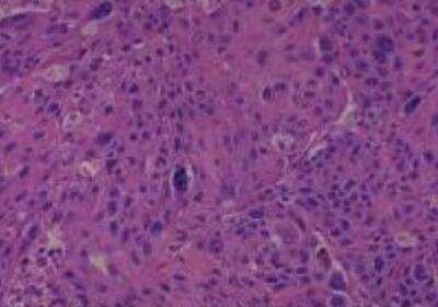 Hematoxylin & Eosin Stain: Human Lung Tissue MicroArray (Cancer metastasis) [NBP2-30222] -  07. Lung, squamous cell carcinoma