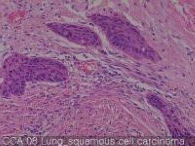 Hematoxylin & Eosin Stain: Human Lung Tissue MicroArray (Cancer metastasis) [NBP2-30222] - 08. Lung, squamous cell carcinoma