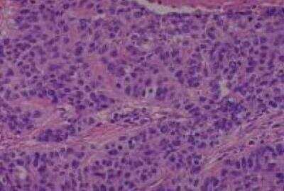 Hematoxylin & Eosin Stain: Human Lung Tissue MicroArray (Cancer metastasis) [NBP2-30222] - 09. Lung, squamous cell carcinoma