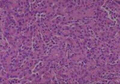 Hematoxylin & Eosin Stain: Human Lung Tissue MicroArray (Cancer metastasis) [NBP2-30222] - 10. Lung adenocarcinoma