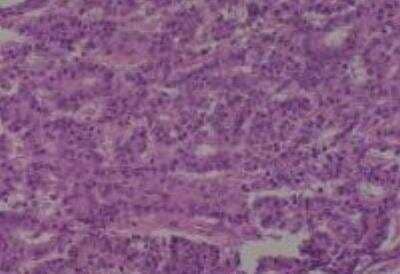 Hematoxylin & Eosin Stain: Human Lung Tissue MicroArray (Cancer metastasis) [NBP2-30222] - 11. Lung adenocarcinoma