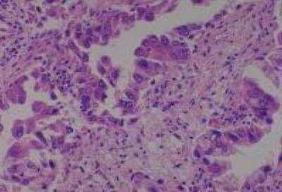 Hematoxylin & Eosin Stain: Human Lung Tissue MicroArray (Cancer metastasis) [NBP2-30222] - Lung adenocarcinoma