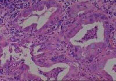 Hematoxylin & Eosin Stain: Human Lung Tissue MicroArray (Cancer metastasis) [NBP2-30222] - 13. Lung adenocarcinoma