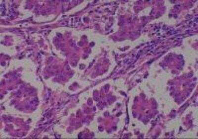 Hematoxylin & Eosin Stain: Human Lung Tissue MicroArray (Cancer metastasis) [NBP2-30222] - 14. Lung bronchioloalveolar carcinoma