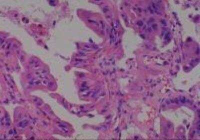 Hematoxylin & Eosin Stain: Human Lung Tissue MicroArray (Cancer metastasis) [NBP2-30222] - 15. Lung, bronchioloalveolar carcinoma