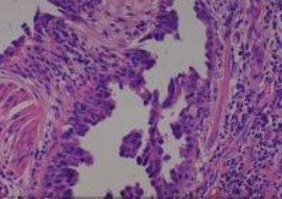 Hematoxylin & Eosin Stain: Human Lung Tissue MicroArray (Cancer metastasis) [NBP2-30222] - 16. Lung, bronchioloalveolar carcinoma