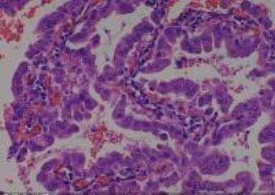 Hematoxylin & Eosin Stain: Human Lung Tissue MicroArray (Cancer metastasis) [NBP2-30222] - 17. Lung bronchioloalveolar carcinoma