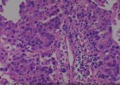 Hematoxylin & Eosin Stain: Human Lung Tissue MicroArray (Cancer metastasis) [NBP2-30222] -  18. Lung adenosquamous carcinoma