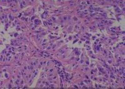 Hematoxylin & Eosin Stain: Human Lung Tissue MicroArray (Cancer metastasis) [NBP2-30222] - 19. Lung, adenosquamous carcinoma
