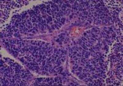 Hematoxylin & Eosin Stain: Human Lung Tissue MicroArray (Cancer metastasis) [NBP2-30222] -  20. Lung small cell carcinoma