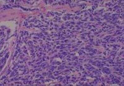 Hematoxylin & Eosin Stain: Human Lung Tissue MicroArray (Cancer metastasis) [NBP2-30222] - 21. Lung small cell carcinoma