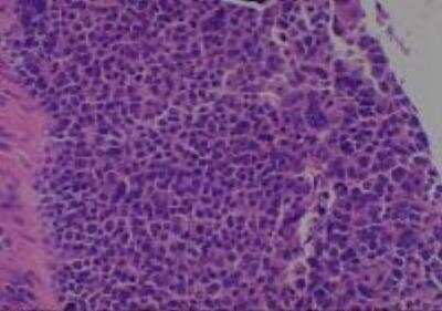 Hematoxylin & Eosin Stain: Human Lung Tissue MicroArray (Cancer metastasis) [NBP2-30222] -  22. Lung, combined small cell and adenacarcinoma