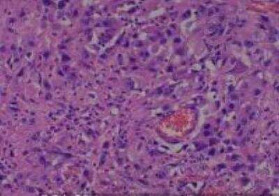Hematoxylin & Eosin Stain: Human Lung Tissue MicroArray (Cancer metastasis) [NBP2-30222] - 23. Lung, large cell carcinoma