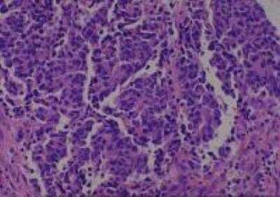 Hematoxylin & Eosin Stain: Human Lung Tissue MicroArray (Cancer metastasis) [NBP2-30222] - 24. Lung, Large cell carcinoma