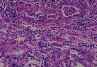 Hematoxylin & Eosin Stain: Human Lung Tissue MicroArray (Cancer metastasis) [NBP2-30222] - 25. Lung, Large cell carcinoma