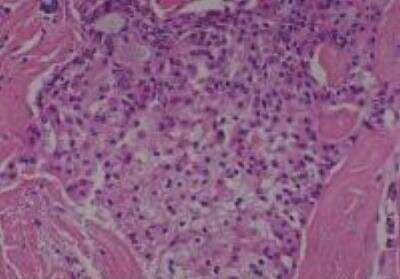 Hematoxylin & Eosin Stain: Human Lung Tissue MicroArray (Cancer metastasis) [NBP2-30222] -  26. Lung, Mucoepidermoid carcinoma