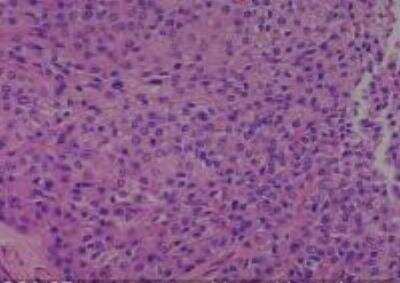 Hematoxylin & Eosin Stain: Human Lung Tissue MicroArray (Cancer metastasis) [NBP2-30222] -  27. Lung, Mucoepidermoid carcinoma