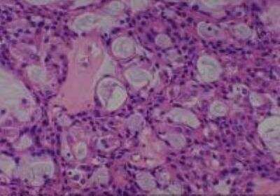 Hematoxylin & Eosin Stain: Human Lung Tissue MicroArray (Cancer metastasis) [NBP2-30222] -  28. Lung, mucoeoidermoid carcinoma