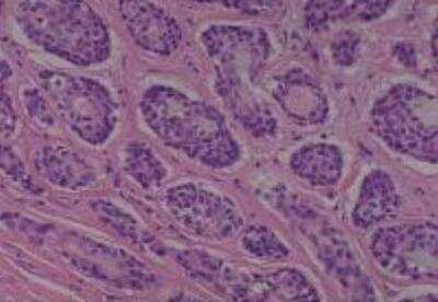 Hematoxylin & Eosin Stain: Human Lung Tissue MicroArray (Cancer metastasis) [NBP2-30222] - 29. Lung, adenoid cystic carcinoma