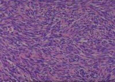 Hematoxylin & Eosin Stain: Human Lung Tissue MicroArray (Cancer metastasis) [NBP2-30222] -  30. Pleura malignant mesothelioma