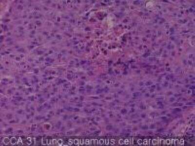 Hematoxylin & Eosin Stain: Human Lung Tissue MicroArray (Cancer metastasis) [NBP2-30222] - 31. Lung squamous cell carcinoma