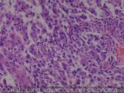 Hematoxylin & Eosin Stain: Human Lung Tissue MicroArray (Cancer metastasis) [NBP2-30222] -  32. Lung squamous cell carcinoma