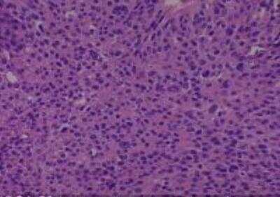 Hematoxylin & Eosin Stain: Human Lung Tissue MicroArray (Cancer metastasis) [NBP2-30222] -  33. Lung squamous cell carcinoma