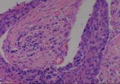 Hematoxylin & Eosin Stain: Human Lung Tissue MicroArray (Cancer metastasis) [NBP2-30222] - 34. Lung squamous cell carcinoma