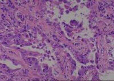 Hematoxylin & Eosin Stain: Human Lung Tissue MicroArray (Cancer metastasis) [NBP2-30222] - 35. Lung adenocarcinoma