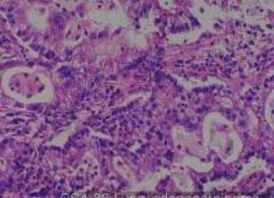 Hematoxylin & Eosin Stain: Human Lung Tissue MicroArray (Cancer metastasis) [NBP2-30222] - 36. Lung adenocarcinoma