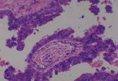 Hematoxylin & Eosin Stain: Human Lung Tissue MicroArray (Cancer metastasis) [NBP2-30222] - 37. Lung adenocarcinoma