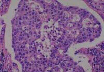 Hematoxylin & Eosin Stain: Human Lung Tissue MicroArray (Cancer metastasis) [NBP2-30222] -  38.  Lung mucinous adenocarcinoma