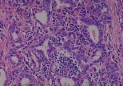 Hematoxylin & Eosin Stain: Human Lung Tissue MicroArray (Cancer metastasis) [NBP2-30222] - 39. Lung adenosquamous cell carcinoma