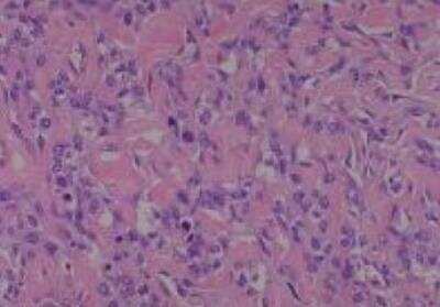 Hematoxylin & Eosin Stain: Human Lung Tissue MicroArray (Cancer metastasis) [NBP2-30222] -  40. Lung, mucoeoidermoid carcinoma