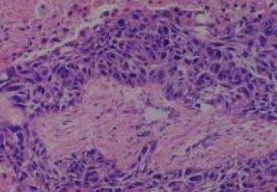 Hematoxylin & Eosin Stain: Human Lung Tissue MicroArray (Cancer metastasis) [NBP2-30222] -  41. Lymph node metastatic carcinoma