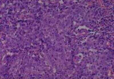 Hematoxylin & Eosin Stain: Human Lung Tissue MicroArray (Cancer metastasis) [NBP2-30222] -  42. Lymph node metastatistic carcinoma