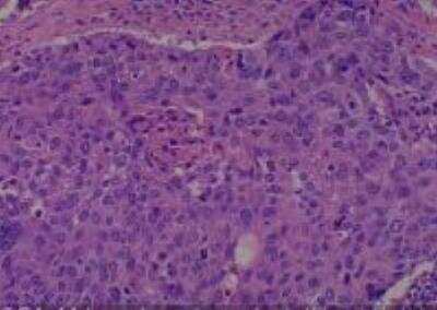 Hematoxylin & Eosin Stain: Human Lung Tissue MicroArray (Cancer metastasis) [NBP2-30222] -  44. Lymph node metastatic Carcinoma